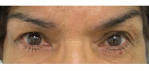 bna1a Right Upper Lid Ptosis After