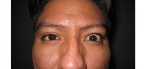 bna2 Right eyelid retraction