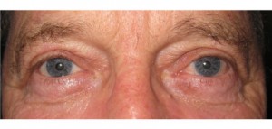 bna3a Bilateral Upper Lid Blepharoplasty After