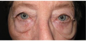 bna5 Bilateral Upper and Lower Lid Blepharoplasty Before
