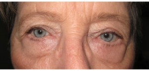 bna5a Bilateral Upper and Lower Lid Blepharoplasty After