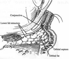 photo2 Stretched Membranes with Formation of Bags