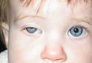 botox1wkpostop 1 Week Postop