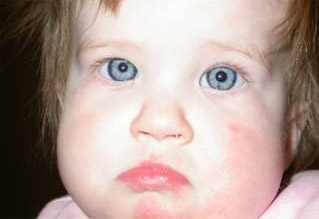 botox3monthpostop 3 Month Postop