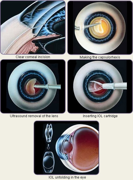  cataract treatments and are nationally and internationally recognized.