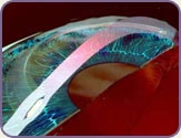 image of intacs