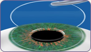 Inlay Ring Inserted Under Corneal Flap