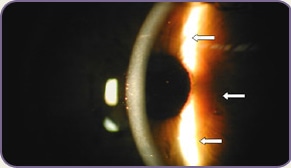 Edge of the Intracorneal Inlay Lens