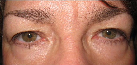 Bilateral Upper Lid Blepharoplasty Before