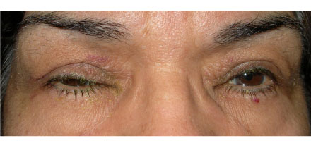 Right Upper Lid Ptosis Before
