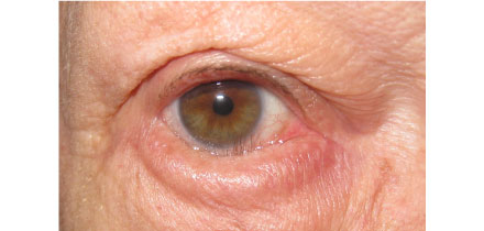 Lower Lid Entropion with Trichiasis