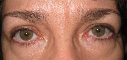 Bilateral Upper Lid Blepharoplasty After