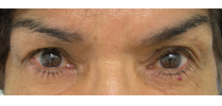 Right Upper Lid Ptosis After