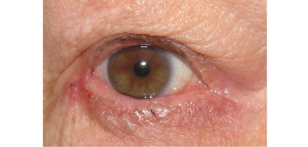 After Entropion Repair