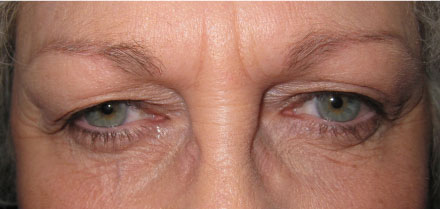 Bilateral Upper Lid Blepharoplasty Before