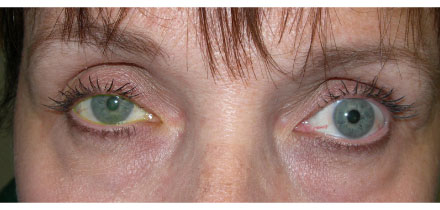 Right Upper Lid Ptosis Before