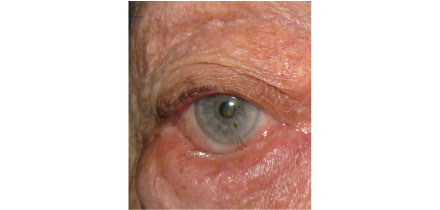Lower Lid Entropion with Trichiasis Before