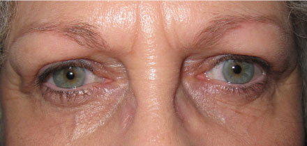 Bilateral Upper Lid Blepharoplasty After