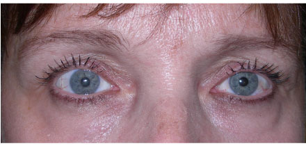 Right Upper Lid Ptosis After