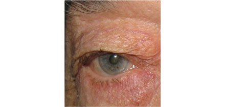 Lower Lid Entropion with Trichiasis After