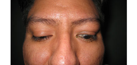 Eye remains open on downgaze
