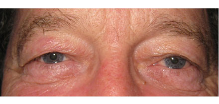 Bilateral Upper Lid Blepharoplasty Before