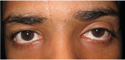 Left Upper Lid Ptosis Before