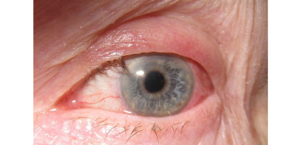 Upper Lid Entropion with Trichiasis