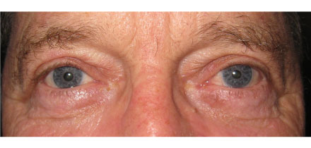Bilateral Upper Lid Blepharoplasty After