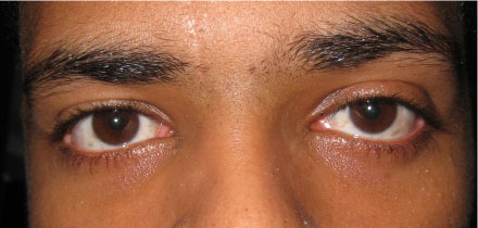 Left Upper Lid Ptosis After
