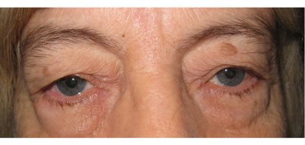 Bilateral Upper and Lower Lid Blepharoplasty Before