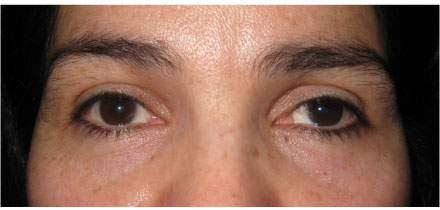 Left Upper Lid Ptosis Before
