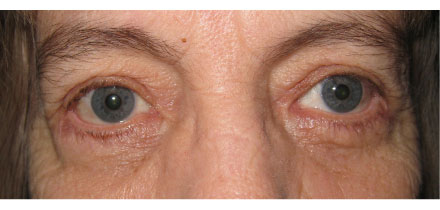 Bilateral Upper and Lower Lid Blepharoplasty After
