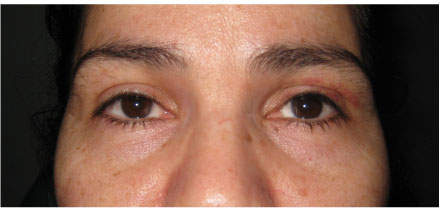 Left Upper Lid Ptosis After
