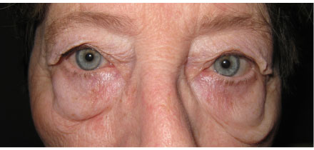 Bilateral Upper and Lower Lid Blepharoplasty Before
