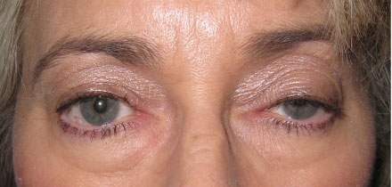 Left Upper Lid Ptosis Before