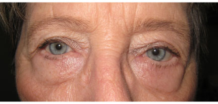 Bilateral Upper and Lower Lid Blepharoplasty After