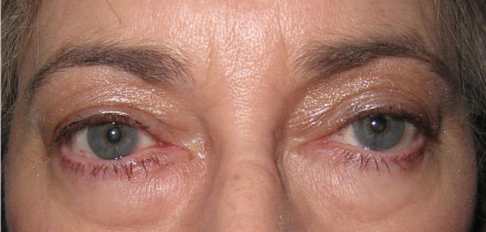 Left Upper Lid Ptosis After