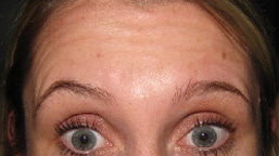 FOREHEAD WRINKLES