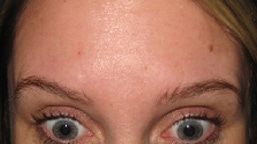 5 DAYS AFTER BOTOX