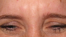 FROWN LINES BEFORE