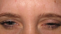 FROWN LINES, 5 DAYS AFTER