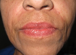 Immediately after 2 Syringes of Juvederm
