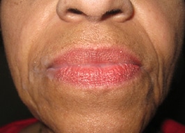 Before Juvederm Filler