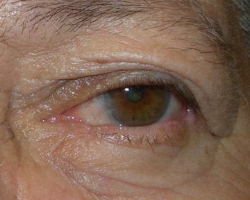 After surgery and reconstruction