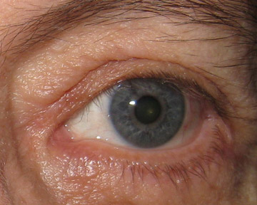 After removal with radiofrequency
