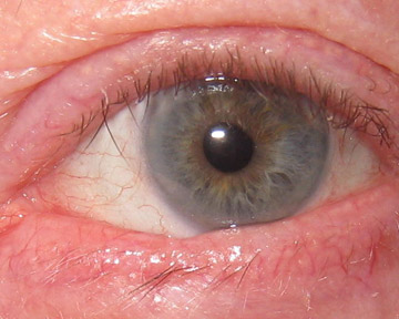 Full thickness wedge removal of skin cancer and reconstruction