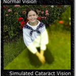 Cataract Graphic