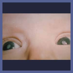 Child Eyes with Glaucoma