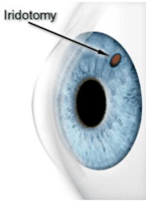 Laser Peripheral Iridotomy graphic